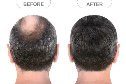 Non Surgical Hair Replacement Service Centre in Kolkata